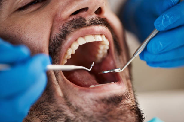 Dental Inlays and Onlays in Lyons, KS